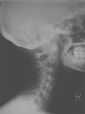 X-Ray Of a Patient's Neck After One Month of Receiving Treatment